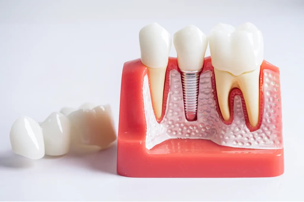 Dental implant diagram